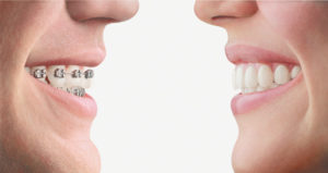 Close-up of two people facing each other, one wearing bracket braces and the other wearing Invisalign aligners